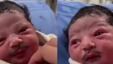 पैदा होते ही बच्चे के चेहरे पर दिखी मूंछ, वीडियो देख डॉक्टर्स भी हैरान!