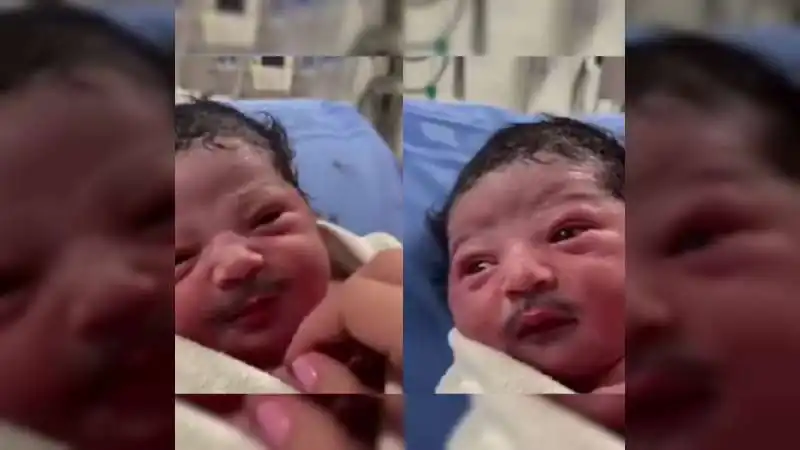 पैदा होते ही बच्चे के चेहरे पर दिखी मूंछ, वीडियो देख डॉक्टर्स भी हैरान!